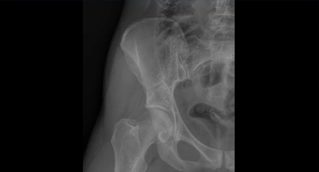 Title image for Hip Anatomy And Disc Pathology In Rowers